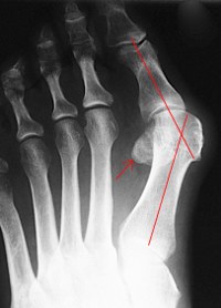 Röntgenaufnahme bei Hallux valgus