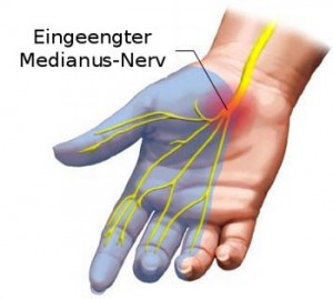 Karpaltunnelsyndrom Richtig Einschätzen Und Behandeln | Gesundheits-Wiki