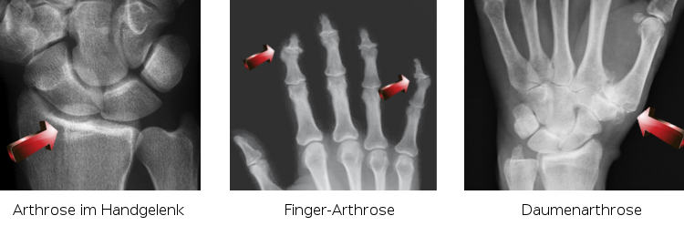 Arthrose Handgelenk, Finger und Daumen