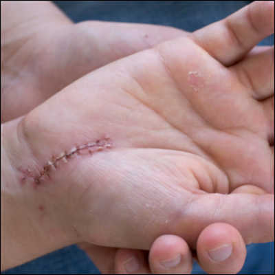 Narbe an der Hand nach einer Operation (CTS)