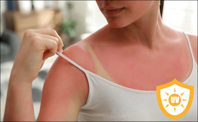 Verbrennung durch UV - Sonnenbrand