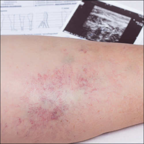Thrombose am Unterschenkel