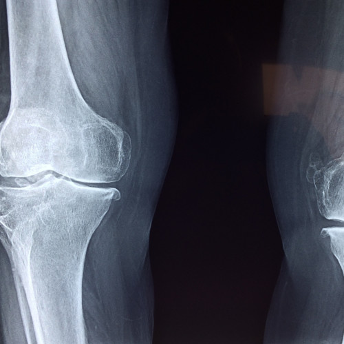 Arthrose im Kniegelenk
