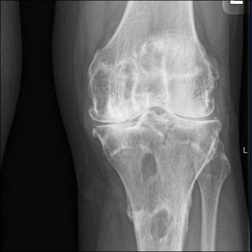 Ausgeprägte Arthrose im Kniegelenk